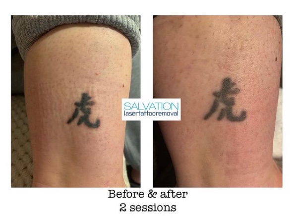 salvation-laser-tattoo-removal-2